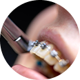Close-up of orthodontic treatment showing braces being adjusted on teeth, relevant to dental insurance coverage options for orthodontics for children and adults.
